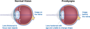 presbyopia-diagram